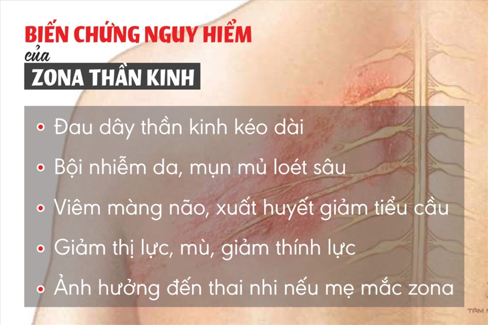 Zona thần kinh là gì? Triệu chứng, nguyên nhân và cách chữa bệnh