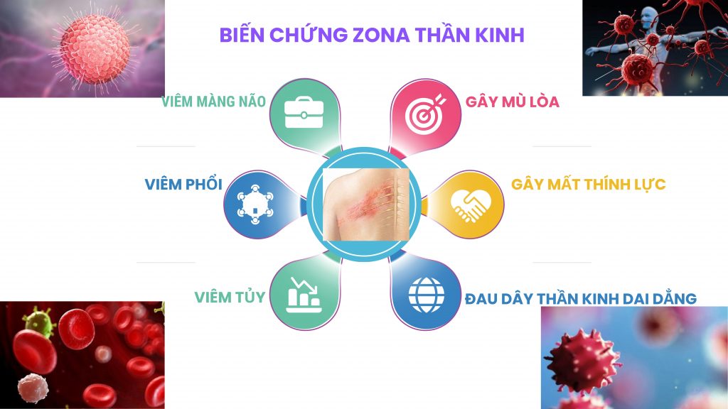 Zona thần kinh: Nguyên nhân, triệu chứng, cách điều trị - Bệnh viện Quốc Tế  Dolife