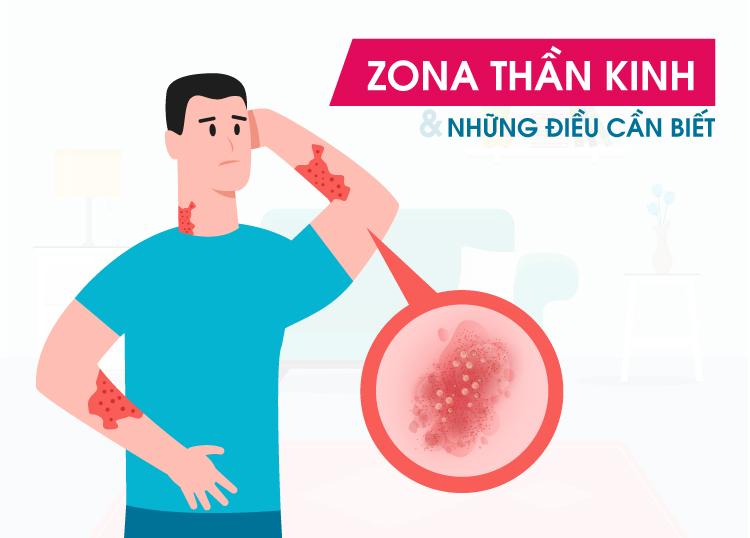 ZONA THẦN KINH & NHỮNG ĐIỀU CẦN BIẾT