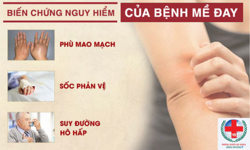 biến chứng mề đay.png