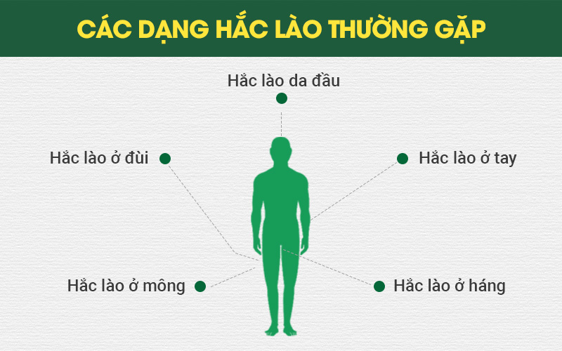 Bệnh hắc lào - Bài thuốc Đông y trị bệnh hiệu quả cho người bệnh hết lao đao