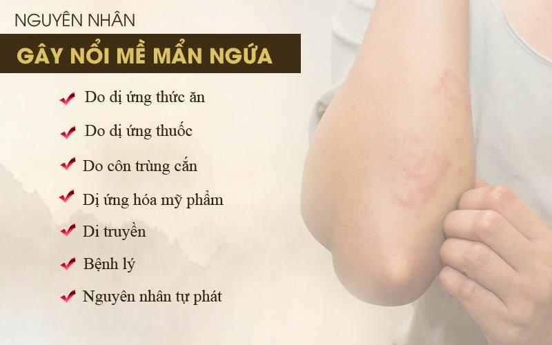 Nổi mề đay mẩn ngứa: Dấu hiệu và cách chữa bệnh bằng bài thuốc thảo dược